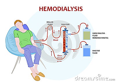 Infographic of hemodialysis, a procedure where a dialysis machine are used to clean blood Stock Photo