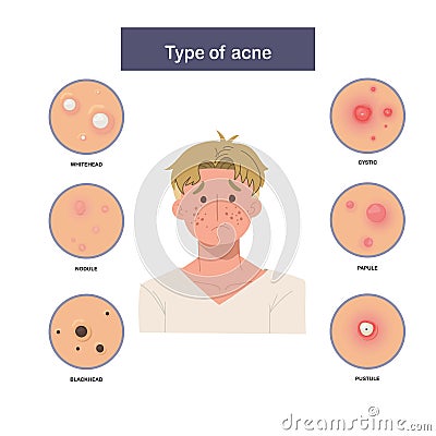 Infographic of Type of acne, sad and worried man with acne. Flat vector illustration Vector Illustration