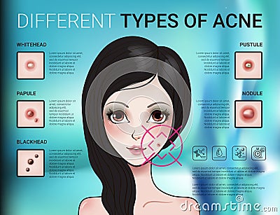 Infographics of different type of skin acne Vector Illustration