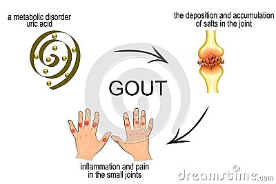 Infographics for disease gout, podagra Vector Illustration