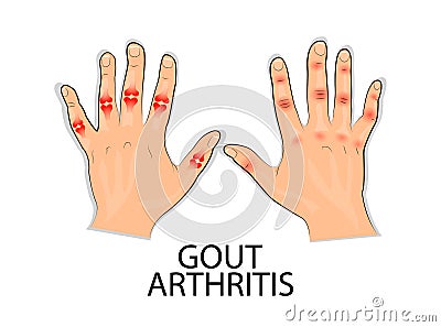 Infographics for disease gout, podagra Vector Illustration