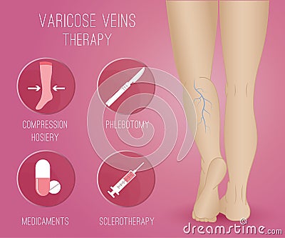 Infographics phlebology, treating varicose veins on women's legs Vector Illustration