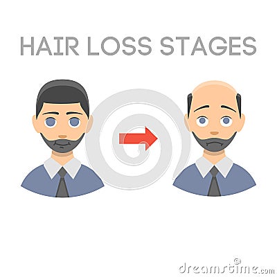 Information chart of hair loss stages types of baldness illustrated on male head vector. Vector Illustration