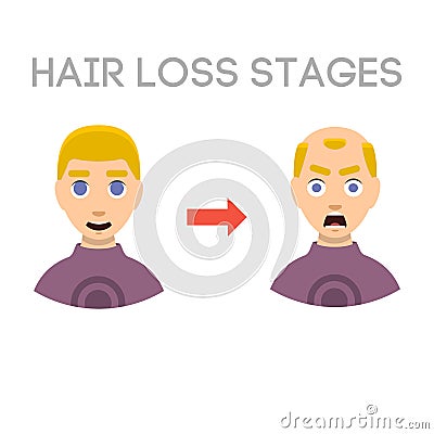 Information chart of hair loss stages types of baldness illustrated on male head vector. Vector Illustration