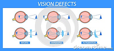 Informative Chart Detailing Myopia, Hyperopia, And Astigmatism In Eye Anatomy. Vector Visual Comparison Vector Illustration