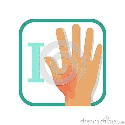 Informative illustration of first-degree burn. Damaged hand with redness, no blisters. Injury concept. Flat vector Vector Illustration