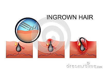 Ingrown hair, pimple ripening Vector Illustration