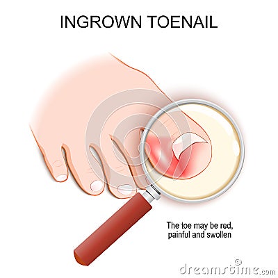 Ingrown toenail. Top view of a magnifying glass and Foot Vector Illustration