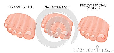 Ingrown Toenail Vector Illustration