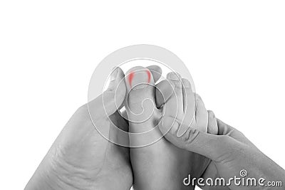 Ingrown toenails on a woman`s foot, isolated on white background, pain in the big toe Stock Photo