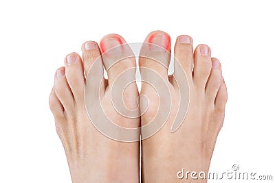 Ingrown toenails on a woman`s foot, isolated on white background, pain in the big toe Stock Photo