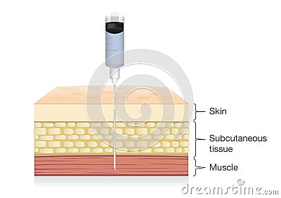 Injection needle insert medications into the muscle layer of skin. Vector Illustration