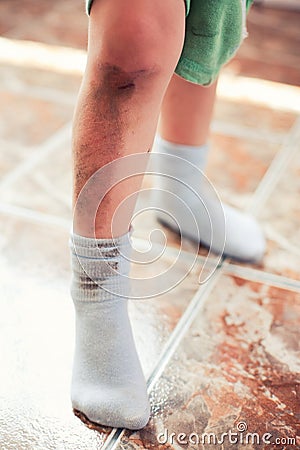 Injured child Stock Photo