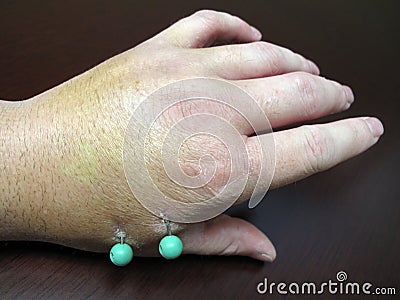 Injured Hand With Surgical Pins Stock Images - Image: 11827524 Injured Hand With Surgical Pins Stock Images - Image: 11827524