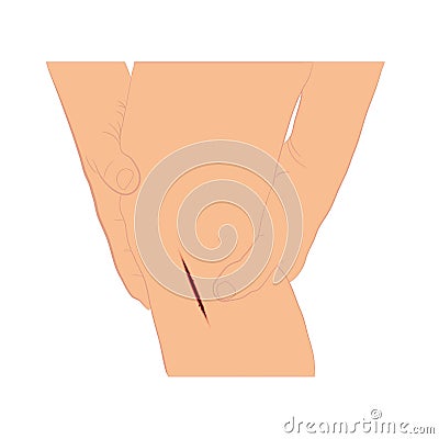 Injured leg with bleeding gash with wound on the leg vector Vector Illustration