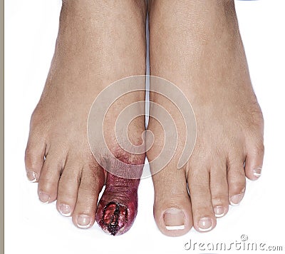 Injured toe special effects make up detail Stock Photo