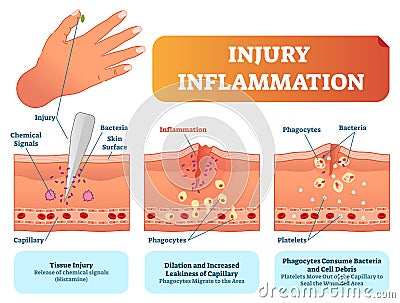 Injury inflammation biological human body response vector illustration scheme. Skin surface injury cross section poster. Vector Illustration