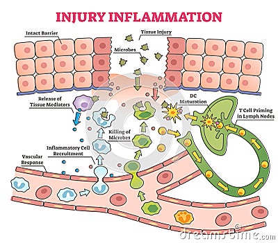 Injury inflammation as body response process in educational outline diagram Vector Illustration