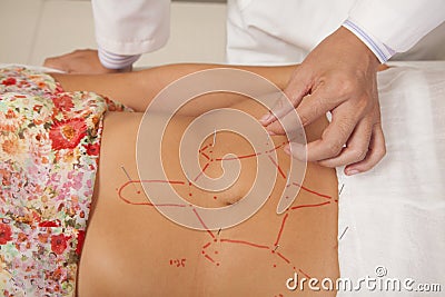 Inserting Acupuncture Needles Stock Photo