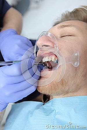 Installation of braces for alignment of the dentition or bite. New braces in the hands of a dentist. Unrecognizable Stock Photo