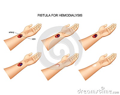 Installation of fistula for hemodialysis Vector Illustration