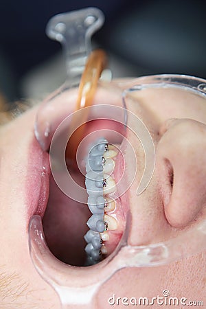 Installing braces on the upper row of teeth.Alignment of the dentition or bite. The concept of beauty and health. Macro Stock Photo