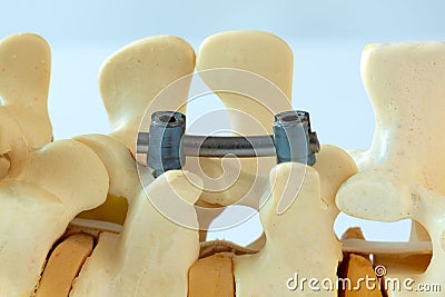 Instrument fixation of human lumbar spine model Stock Photo