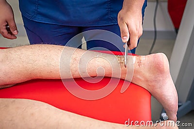 Instrumental mobilization of soft tissues, heel and arch pain treatment. Stock Photo