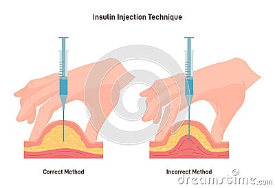 Insulin injection technique. Correct and incorrect way. Cross-section Vector Illustration