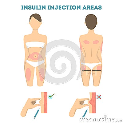 Insulin injections places. Vector Illustration