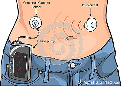 Insulin Pumps for Diabetes Patients Vector Ä°llustration Vector Illustration