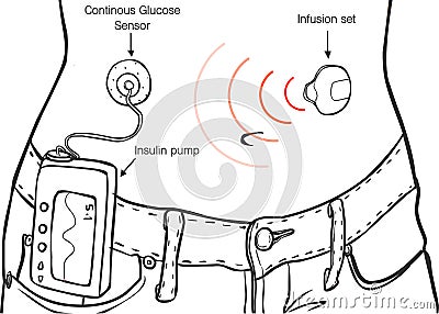 Insulin Pumps for Diabetes Patients Vector Ä°llustration Vector Illustration