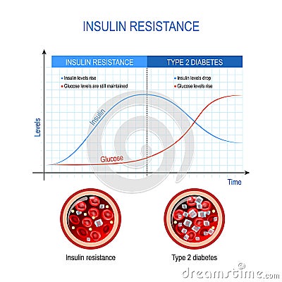 Insulin resistance and Type 2 diabetes Vector Illustration