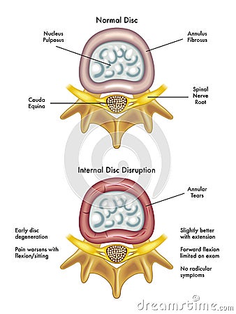 Internal Disc Disruption Royalty Free Stock Photo - Image: 29459965