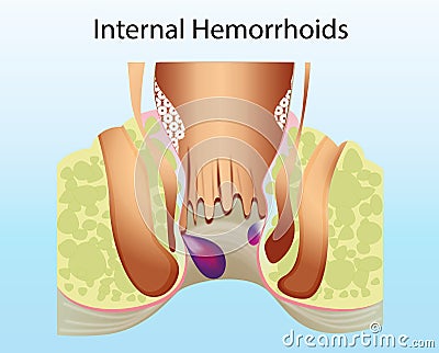 Internal hemorrhoid. Unhealthy lower rectum with inflamed vascular structures Cartoon Illustration