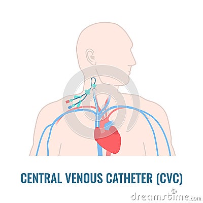 Internal jugular central venous catheter close up Vector Illustration