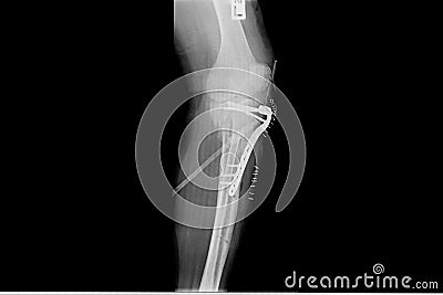Internal of left leg fixed with plate and screws Stock Photo
