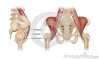 Internal snapping hip Syndrome. Psoas major, Iliopsoas muscle and Snapping area Vector Illustration