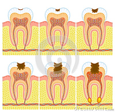 Internal structure of tooth Cartoon Illustration