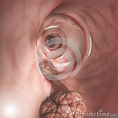 Internal view of the intestinal walls. Colorectal cancer CRC, bowel cancer, colon cancer, or rectal cancer Stock Photo