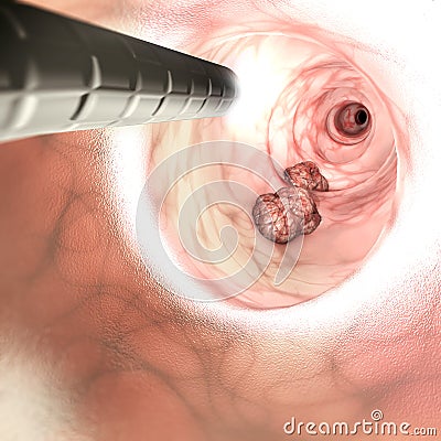 Internal view of the intestinal walls. Colorectal cancer CRC, bowel cancer, colon cancer, or rectal cancer Stock Photo