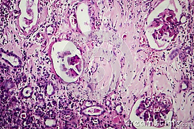 Interstitial nephritis, light micrograph Stock Photo