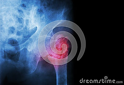 Intertrochanteric ( Neck of femur ) fracture left femur ( Thigh bone ) and blank area at right side Stock Photo