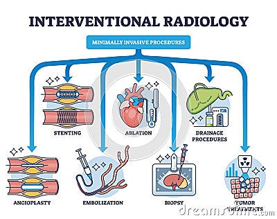 Interventional radiology as minimally invasive procedures outline diagram Vector Illustration