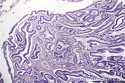 Intestinal adenomas, light micrograph Stock Photo