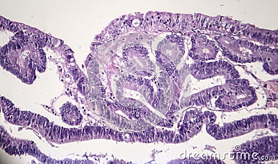 Intestinal adenomas, light micrograph Stock Photo