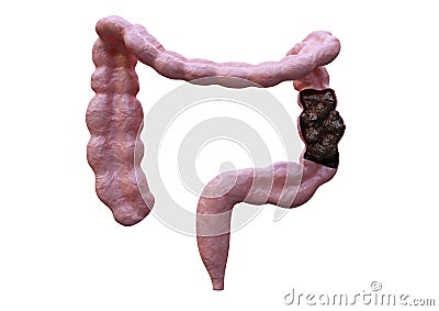 Intestinal constipation. Bowel disorder characterized by difficulty in excreting faeces. Laxatives resolve the disorder Stock Photo