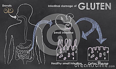 Intestinal Damage of Gluten Stock Photo