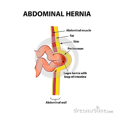 Intestinal hernia. Infographics. Vector illustration on isolated background. Vector Illustration