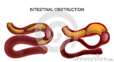 Intestinal obstruction.abdominal surgery Vector Illustration